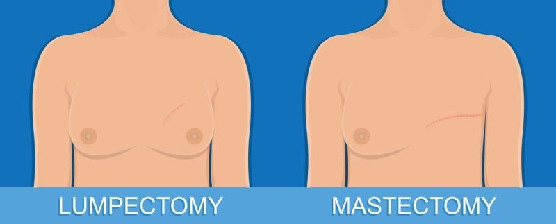 breast cancer: Mastectomy vs. Lumpectomy