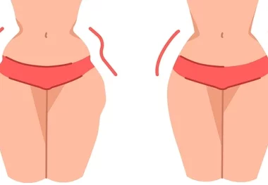 hip dips before and after